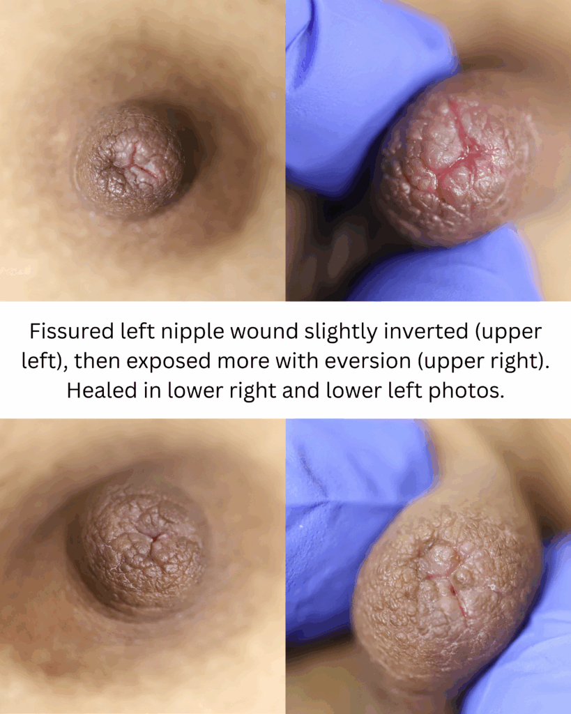 Nipple fissure that is subtle but very painful
