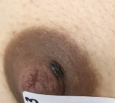 Mole with severe atypia needing excision.