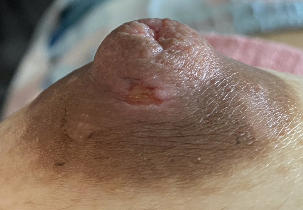 Mole after shave biopsy