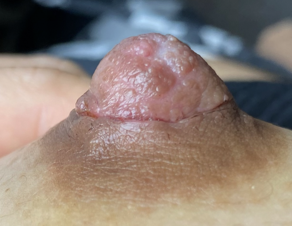 Nipple healing after surgical excision