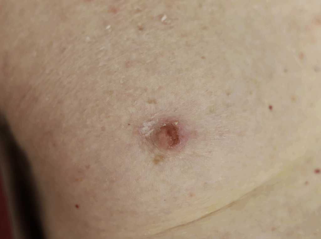 Male paget's disease