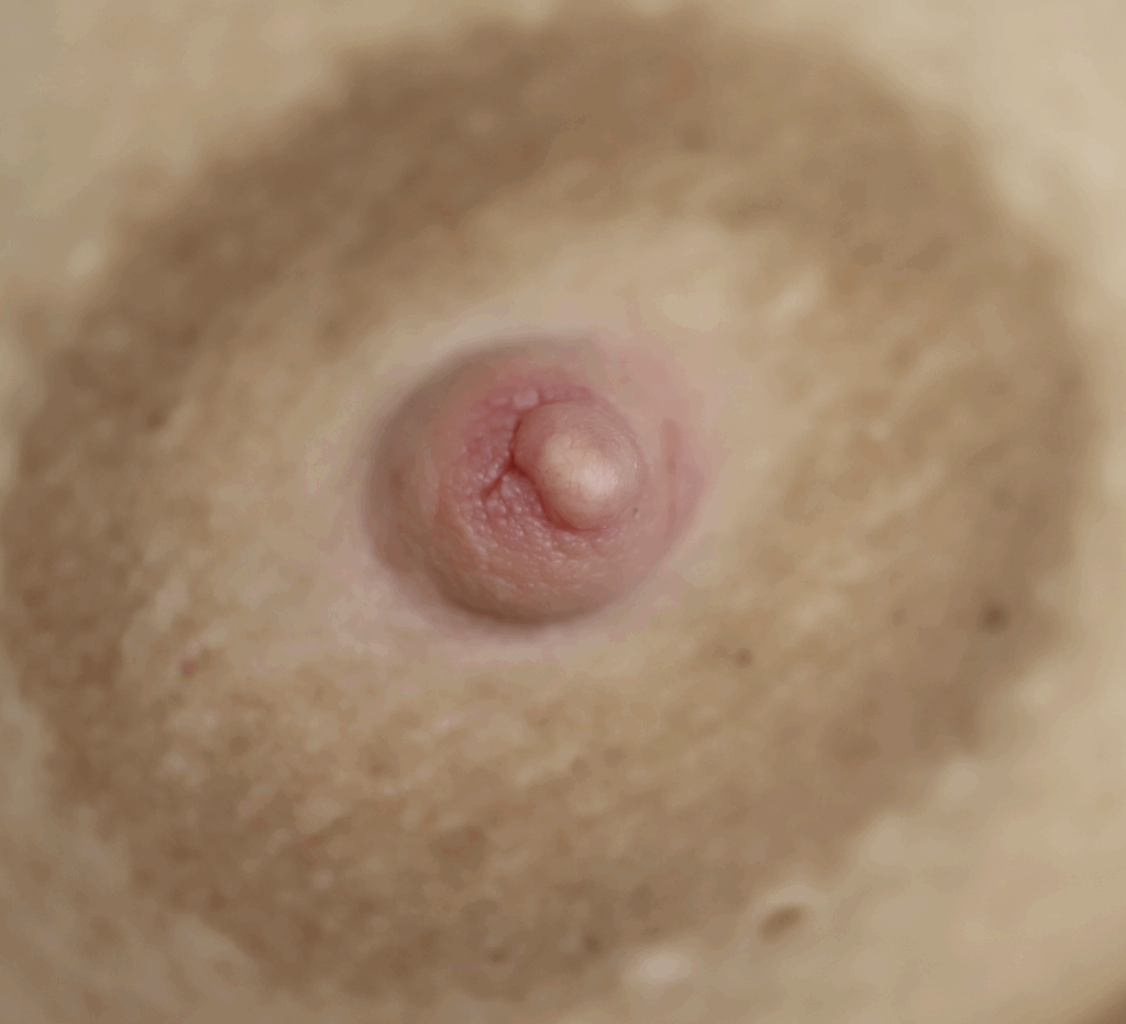 nipple cyst