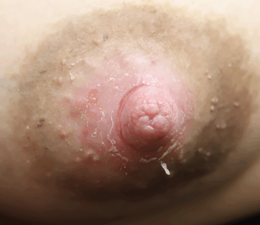 Nipple dermatitis