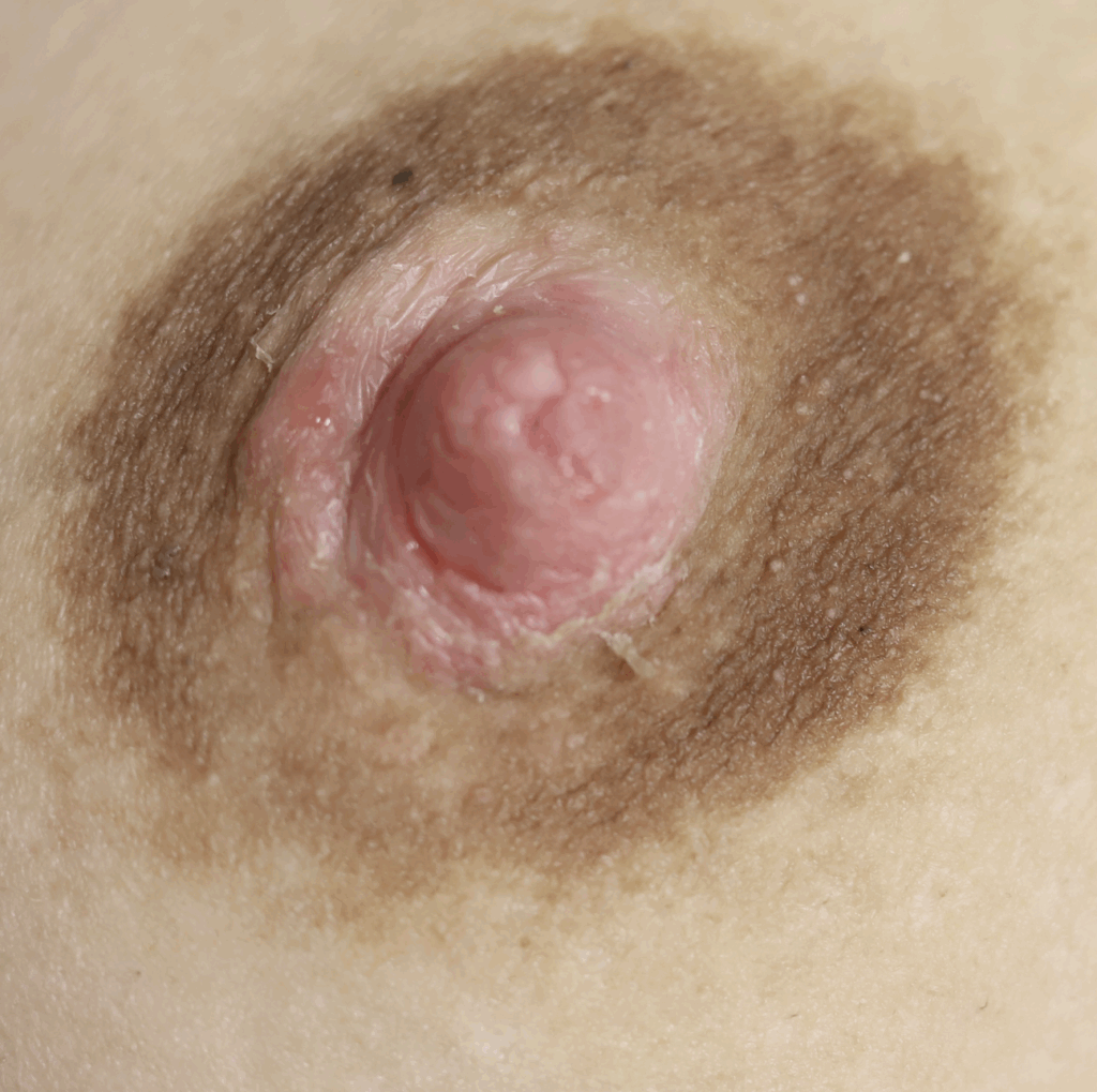 Nipple dermatitis