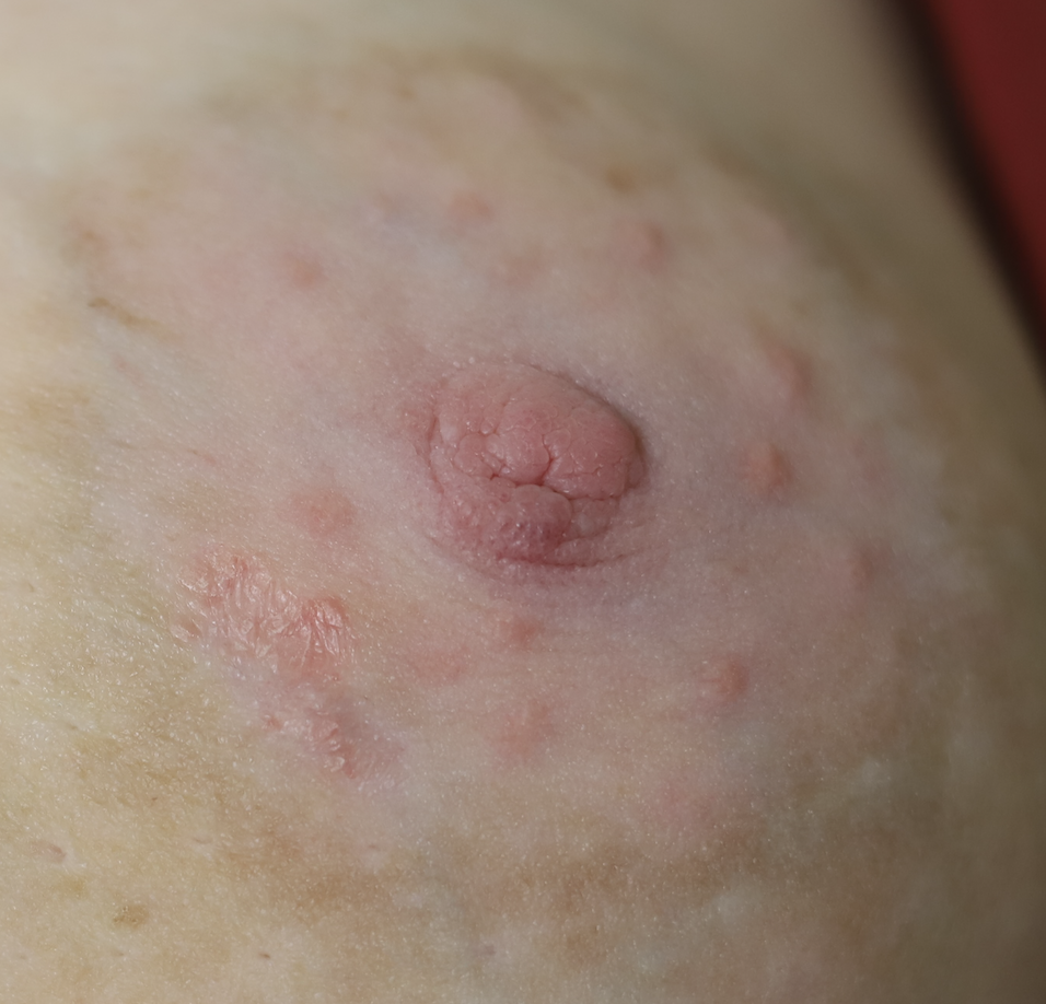 psoriasis
