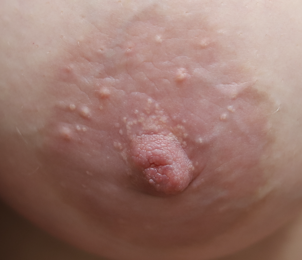 Montgomery gland
