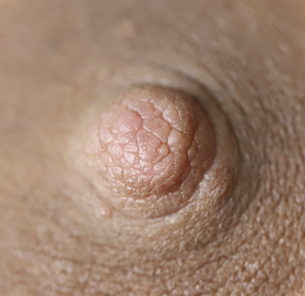sebaceous cyst nipple