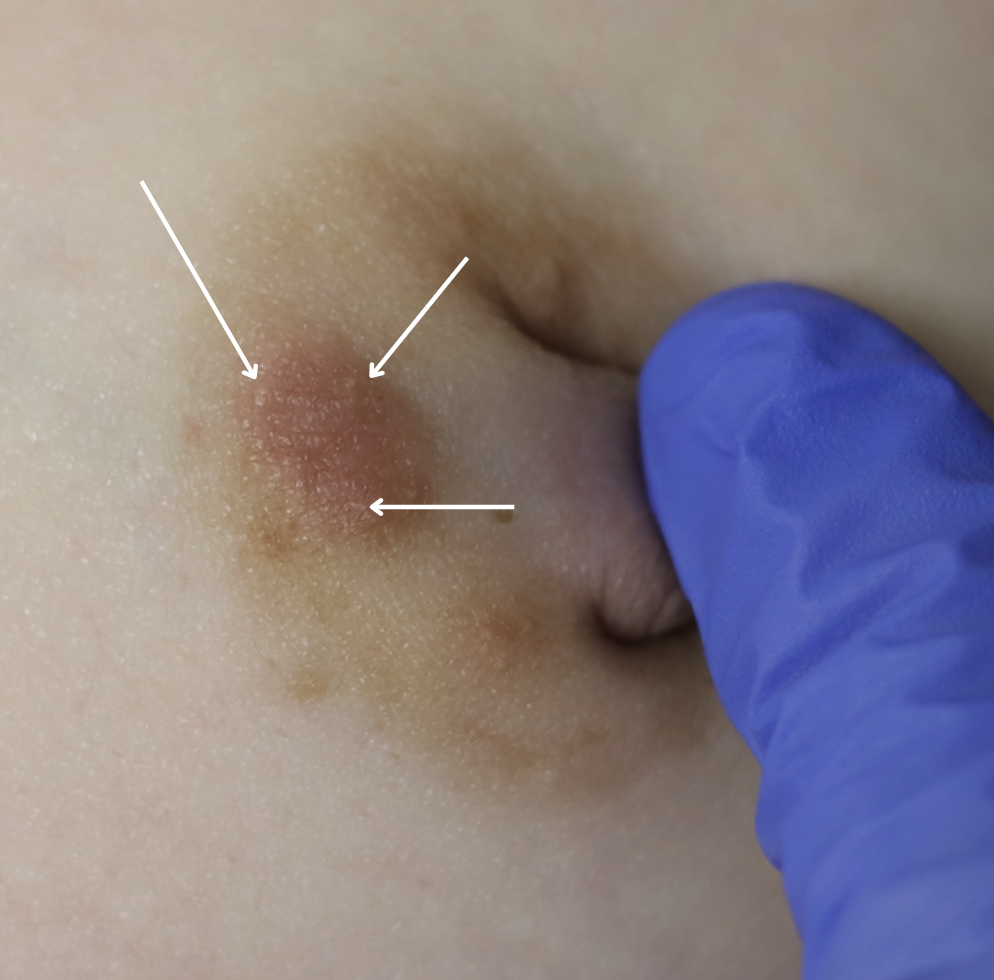 Montgomery gland and cyst on nipple
