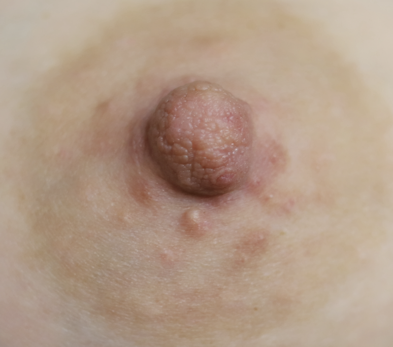 Montgomery gland obstructed by pump. Drains easily with a touch of salicylic acid cream.