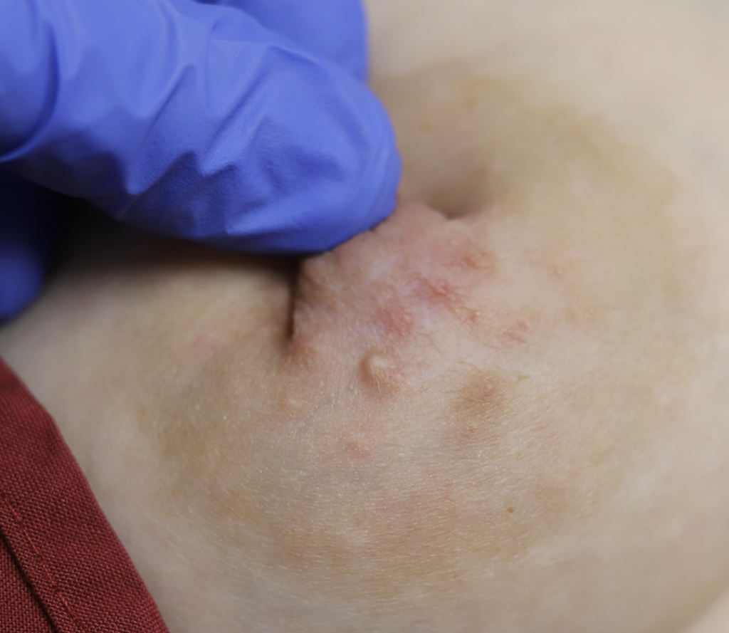 Montgomery gland obstructed by pump. Drains easily with a touch of salicylic acid cream.