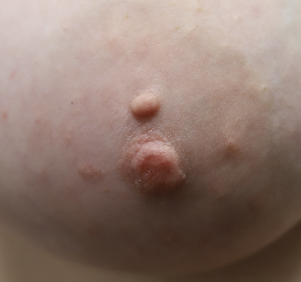 Montgomery gland scarring after repeated squeezing (showed fibrosis on excision).