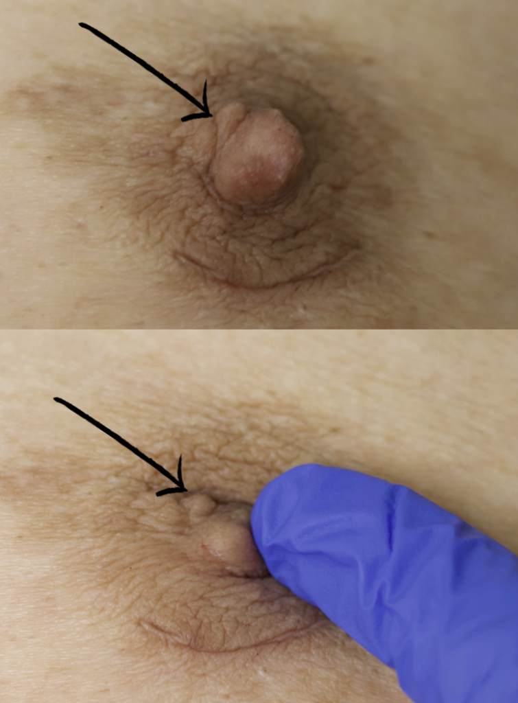 Nipple sebaceous cyst at base of nipple