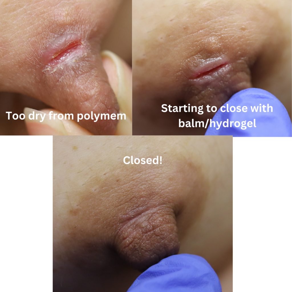 Too dry from polymem