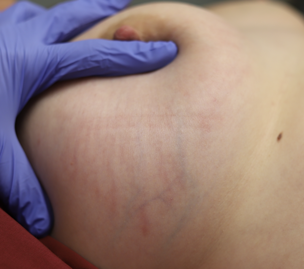 stretch marks on breast