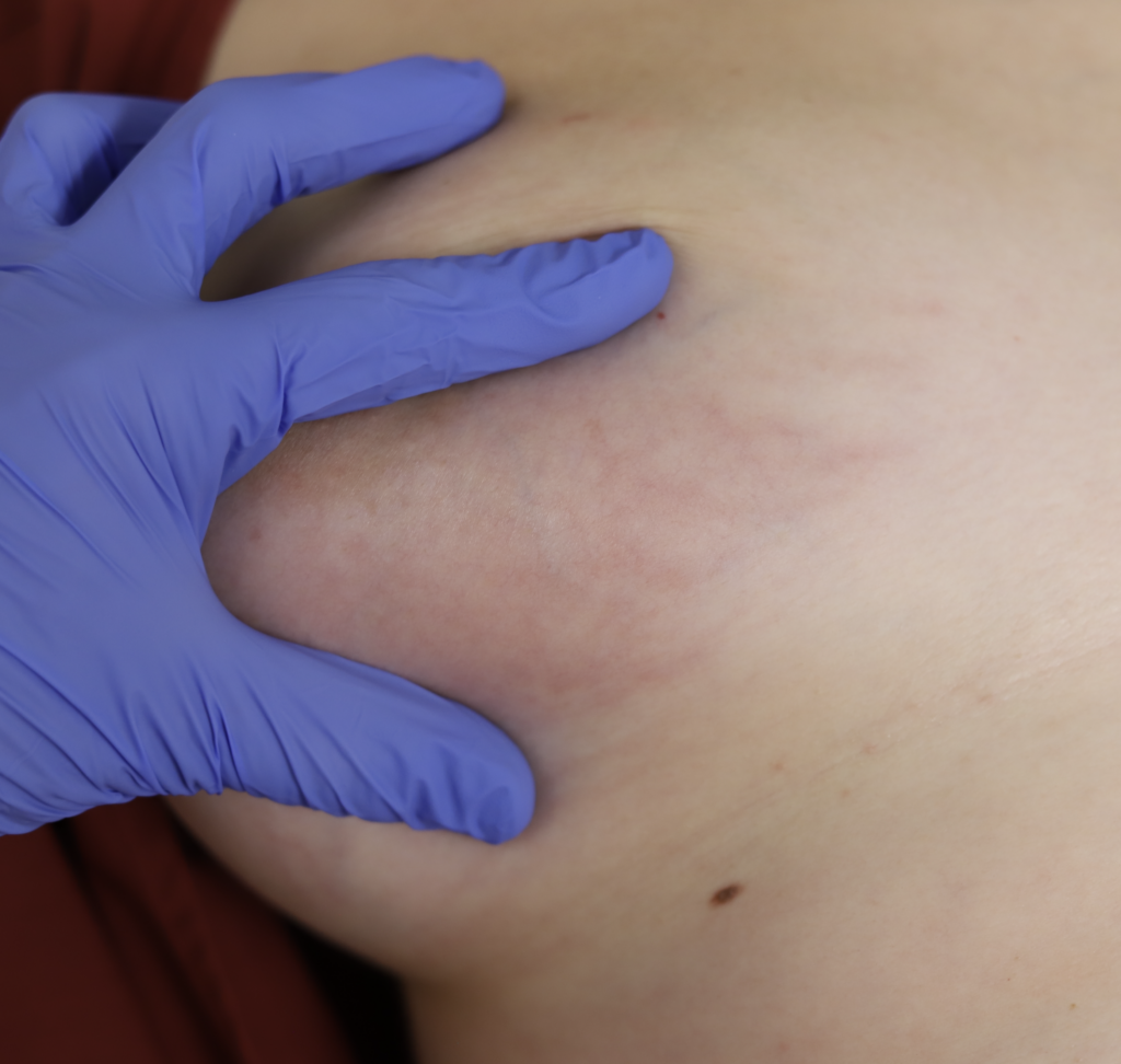 stretch marks on breast