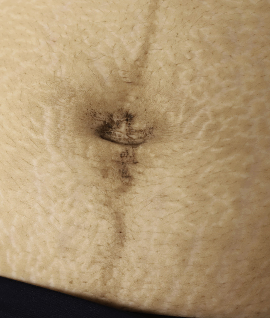 Umbilicus seborrheic keratosis