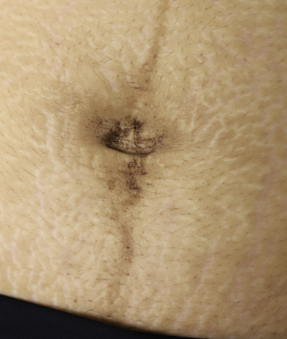 Umbilicus seborrheic keratosis