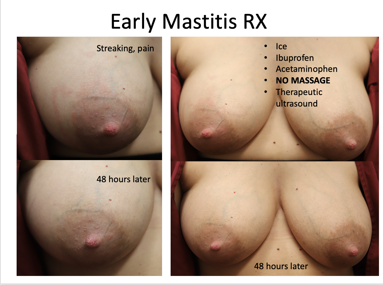mastitis treatment