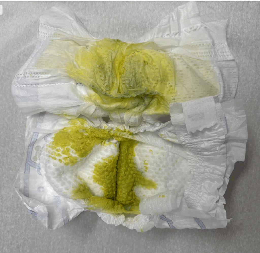 Hyperlactation oversupply