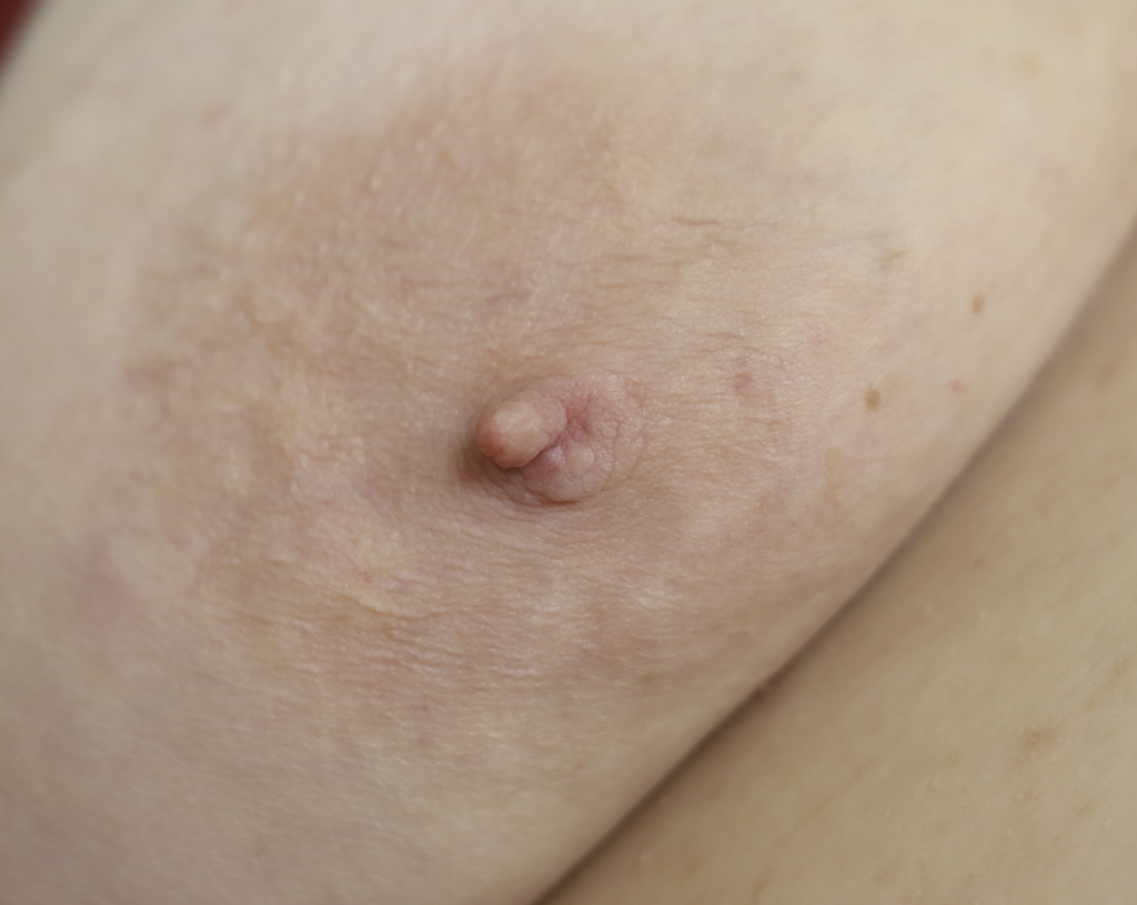 Neuroma on right nipple (neuroma is top part and native nipple is bottom)